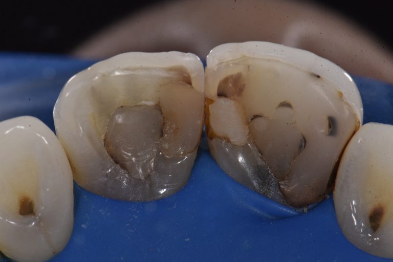 Internal Bleaching Dark Root Canal Treated Teeth Cosmetic Dentistry