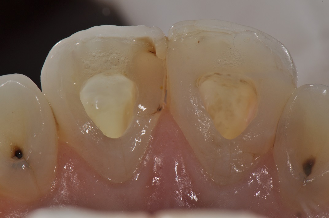 Internal Bleaching Dark Root Canal Treated Teeth Cosmetic Dentistry