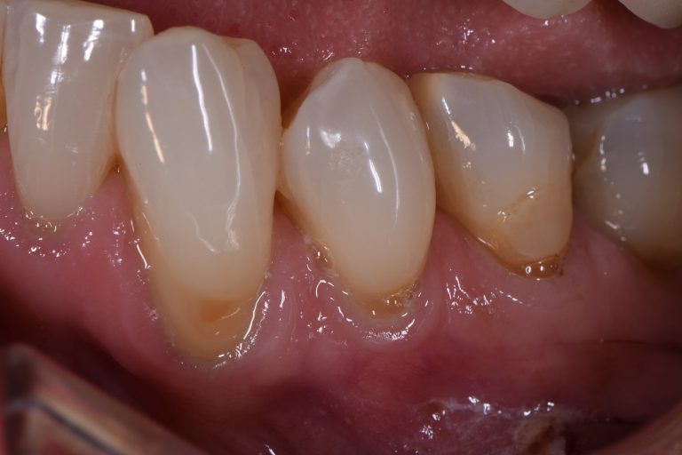 Abrasion Lesions Cosmetic Dentist Newmarket and Devonport Auckland