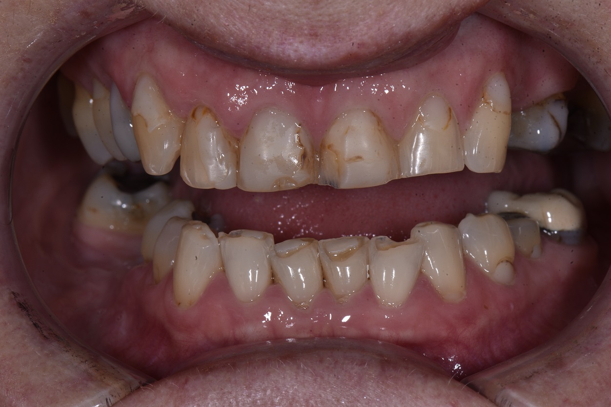 Full Dental Reconstruction Occlusal Wear and Rehabilitation