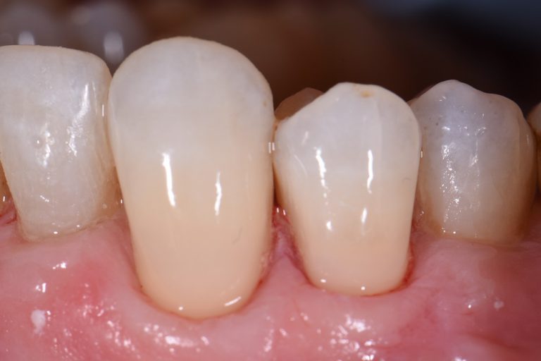 Reversing Cervical Abrasion Cosmetic Dentist Auckland