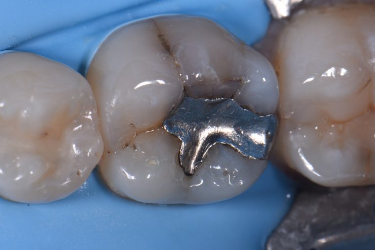 Cracked Teeth with Amalgam Fillings Rejuvenated