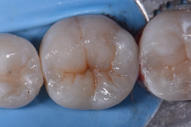 Cracked Teeth with Amalgam Fillings Rejuvenated