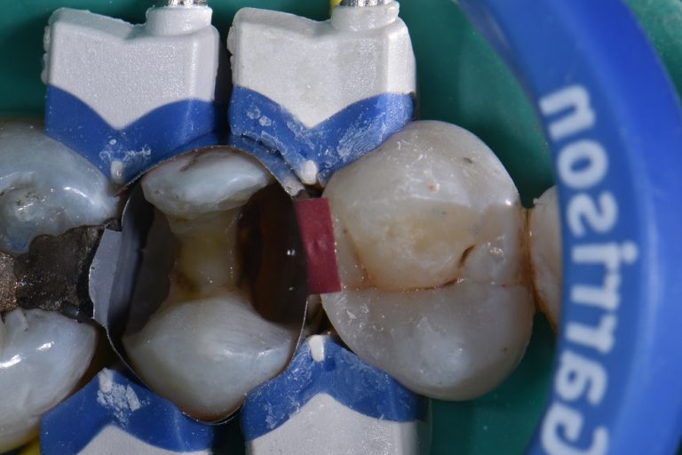 Safe Amalgam Removal Precision Restorative Dentist