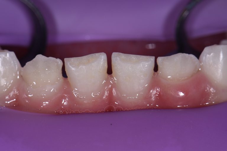 Severe Enamel Dysplasia NonInvasive Restorative Dentistry