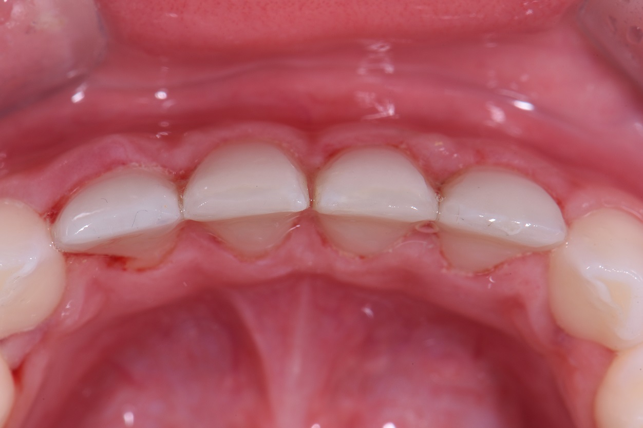 Severe Enamel Dysplasia NonInvasive Restorative Dentistry