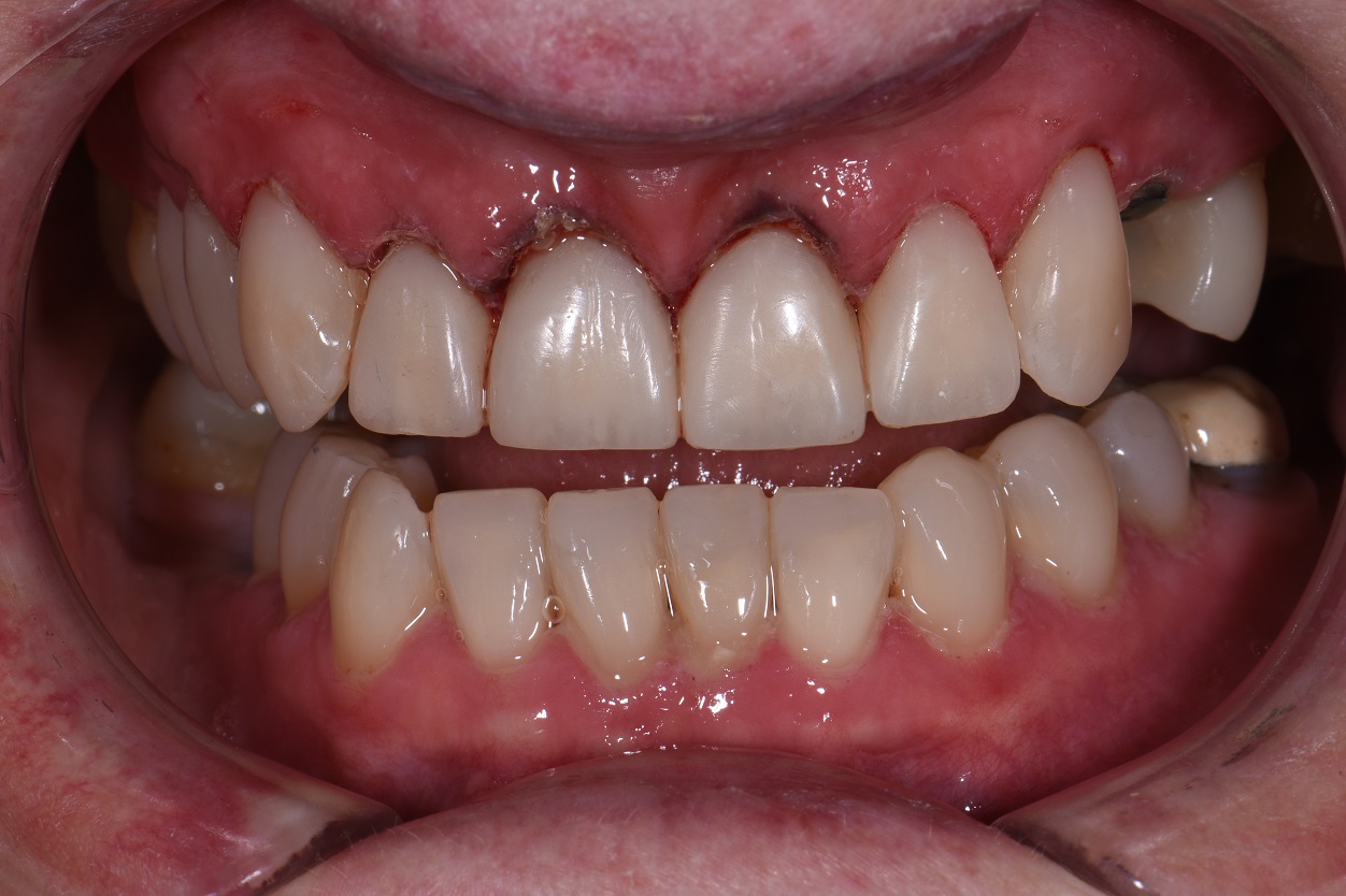 Full Dental Reconstruction Occlusal Wear and Rehabilitation