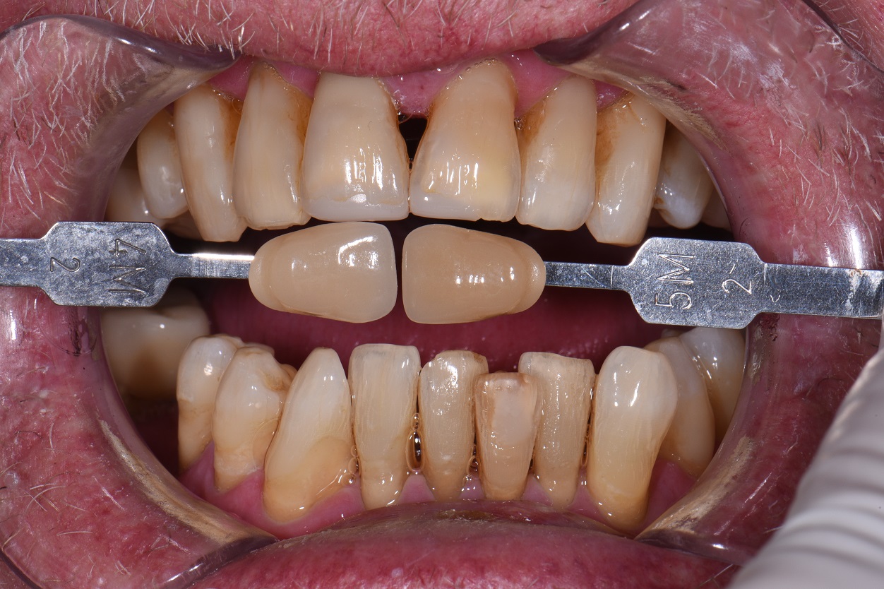 The Godfather Esthetic Solution Custom Bleaching Trays