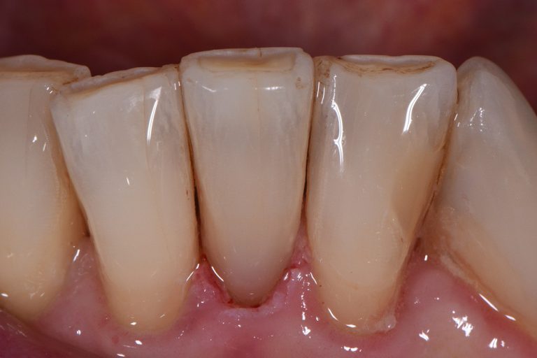 Reversing Root Wear Restorative Dentistry Auckland