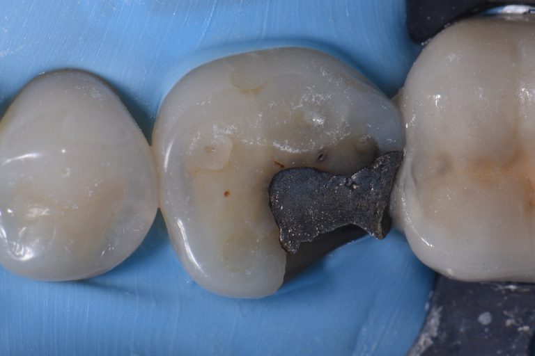 Severely Broken Down Posterior Teeth Complex Composite Fillings