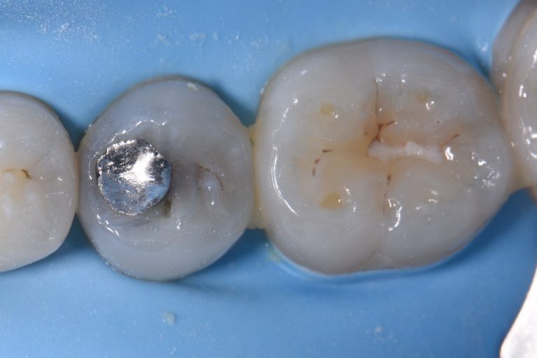 Functional and Esthetic Biomimicry Restorative Dentist Auckland