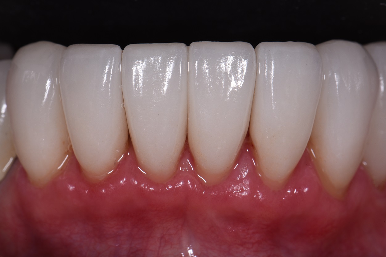 Black Triangles Lower Porcelain Veneers Cosmetic Dentist Auckland