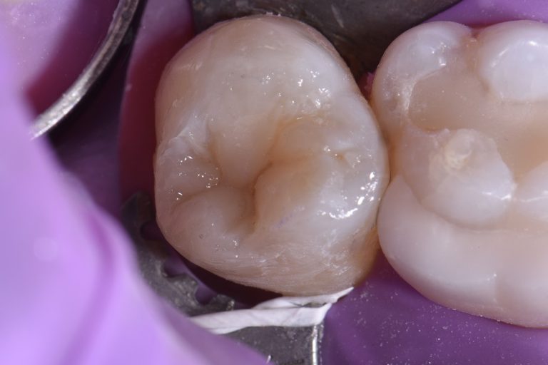 Broken Cusp Restored using a Restorative Dentist Auckland