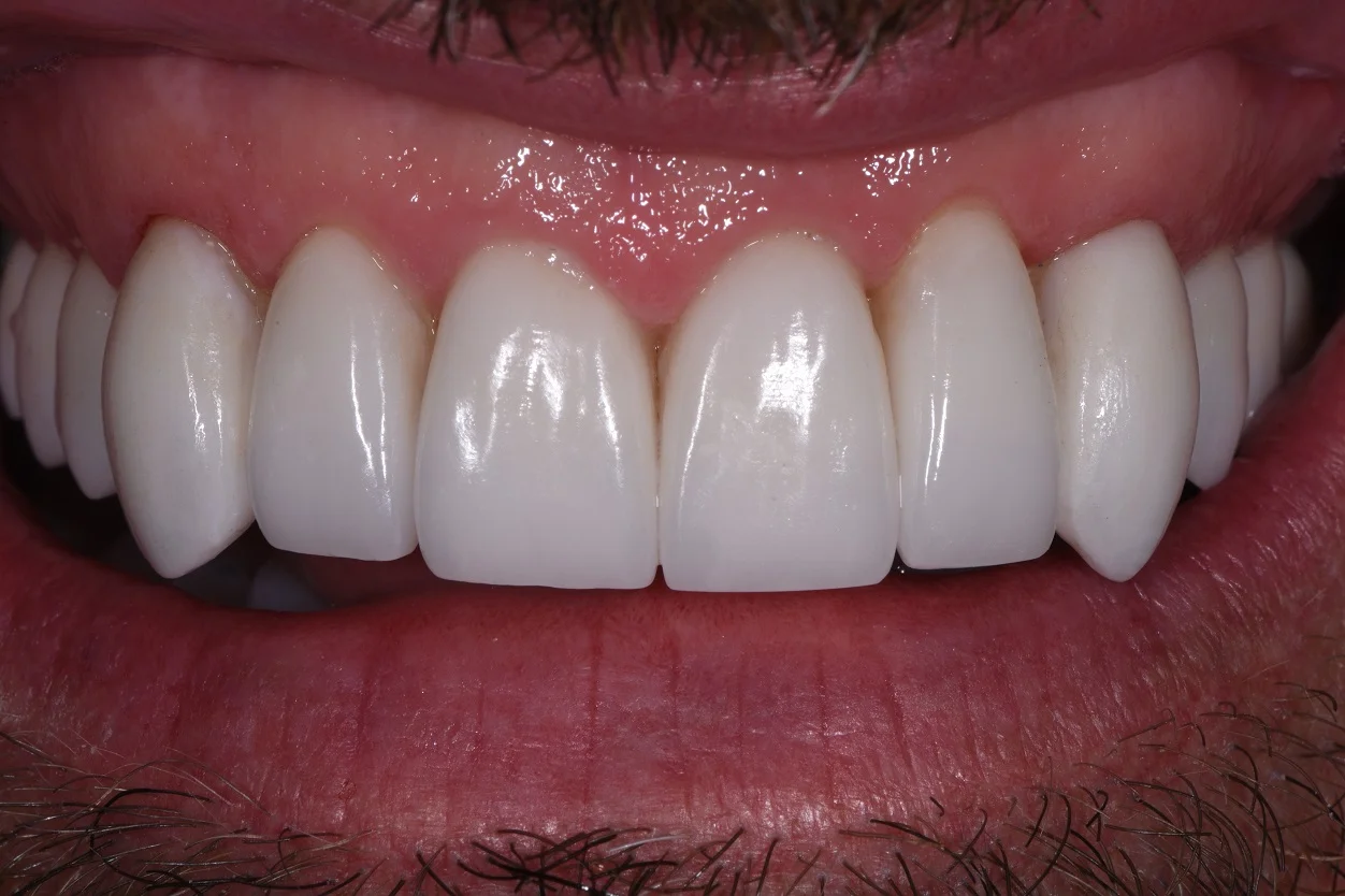 Permanent Vampire Teeth Implants