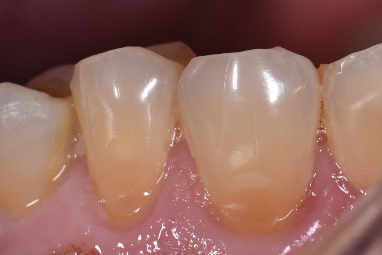 Beautiful Composite Dentistry Cosmetic Dentist Auckland