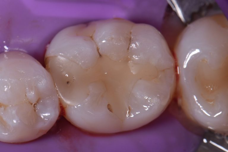 Sculpting Ceramic Fillings by Hand Restorative Dentist Auckland