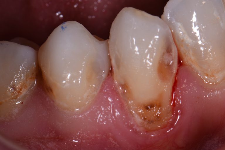 Cervical Caries Cavities At The Necks Of Teeth