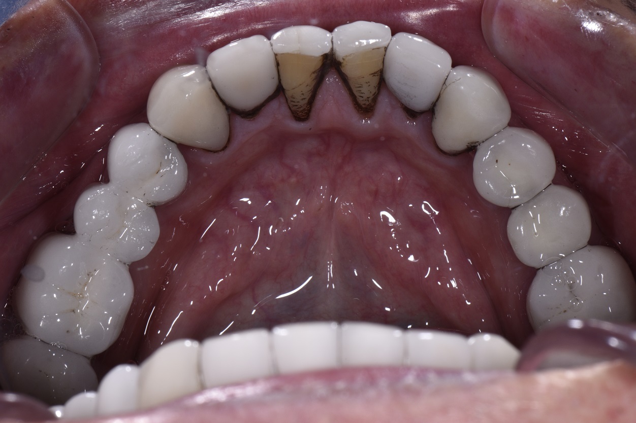 Severe Staining from Floradix Iron Supplement Staining on Teeth