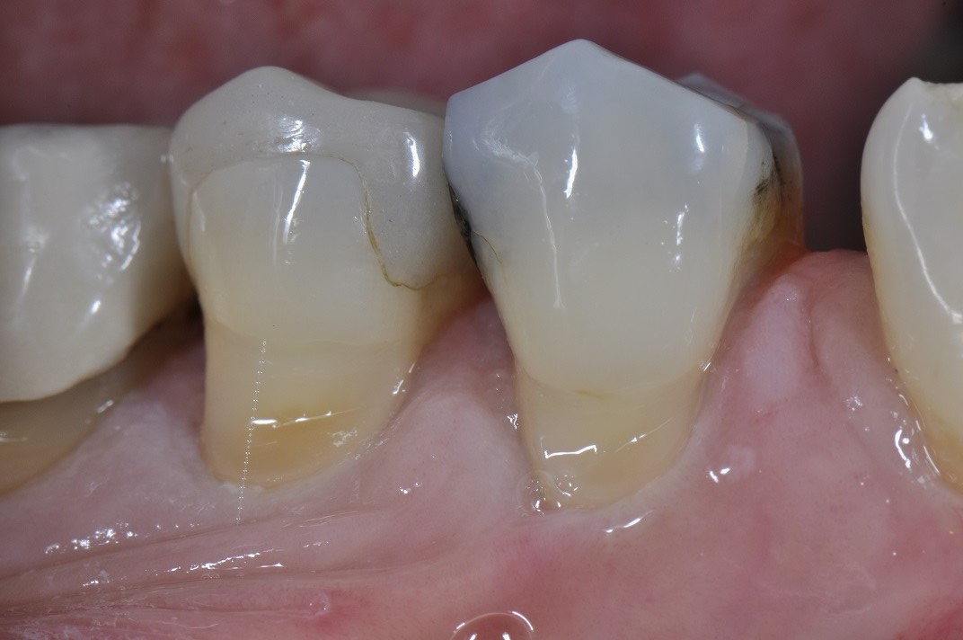 Cervical Abrasion Composite Resin Restorations