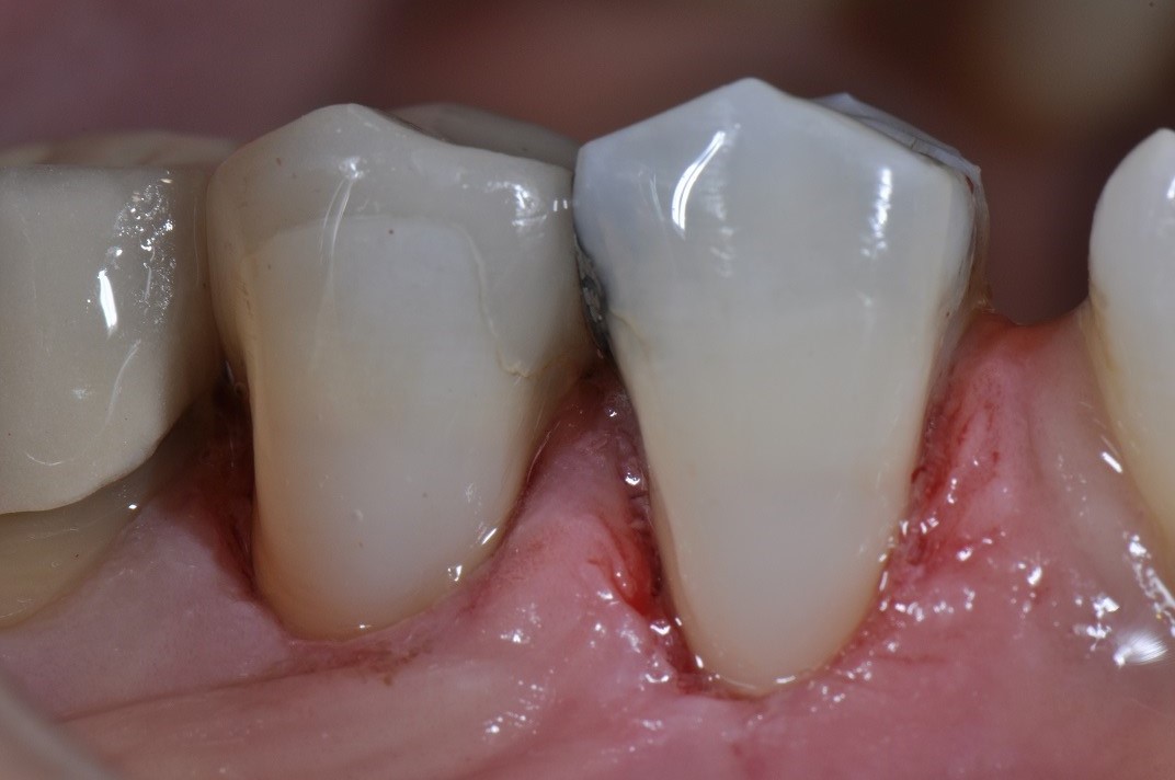 Cervical Abrasion Composite Resin Restorations
