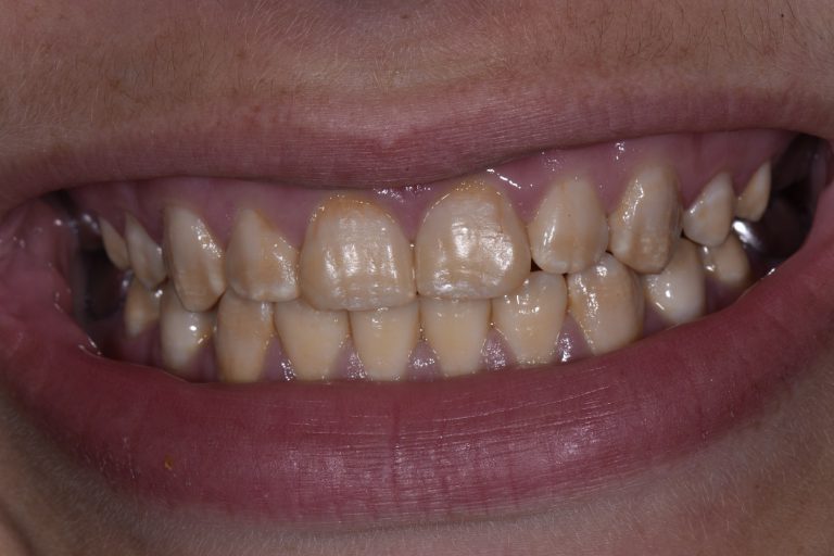 Tooth Whitening Dental Whitening Vital Custom Nightguard Bleaching