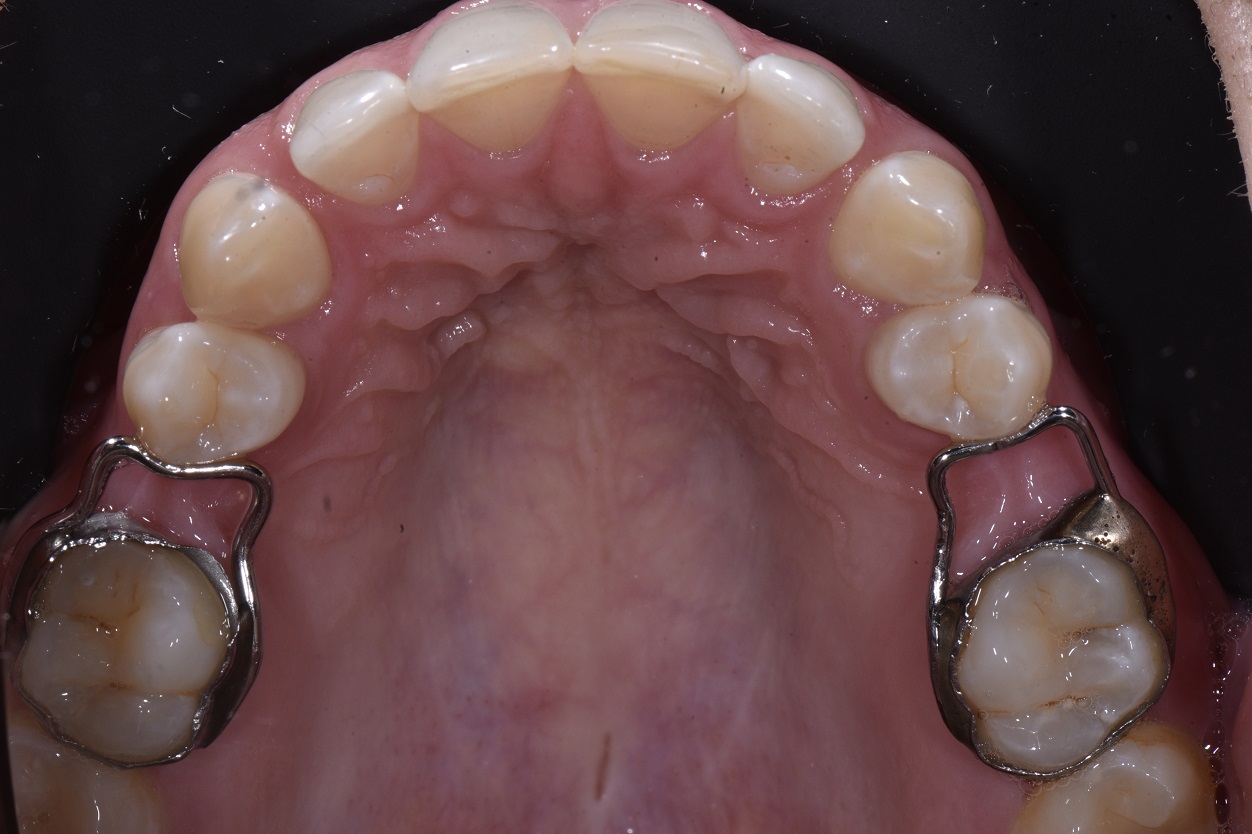 Cantilever Bridge Dental Procedure