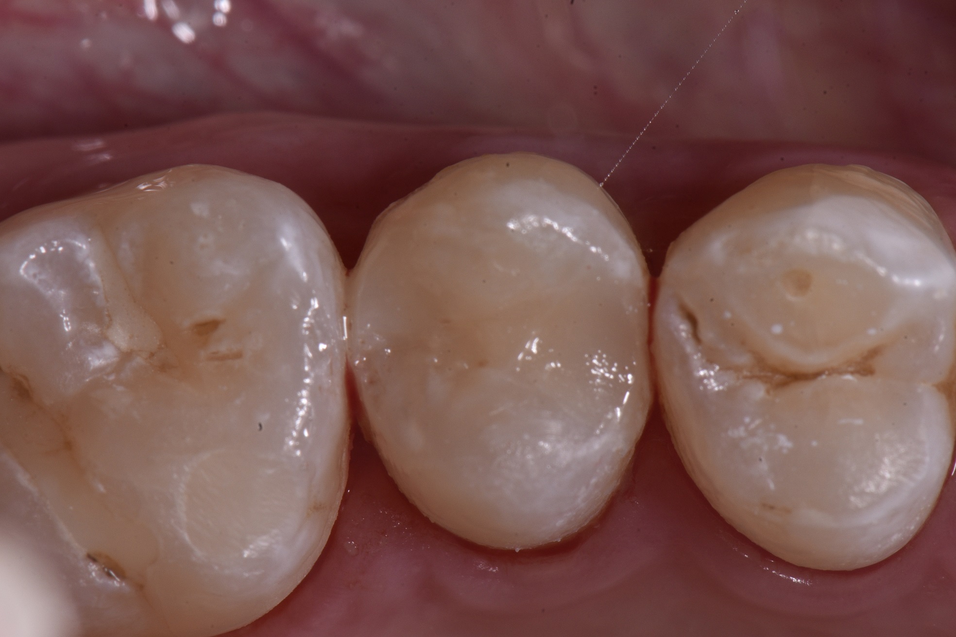 Cosmetic Dentist Auckland White Fillings Auckland