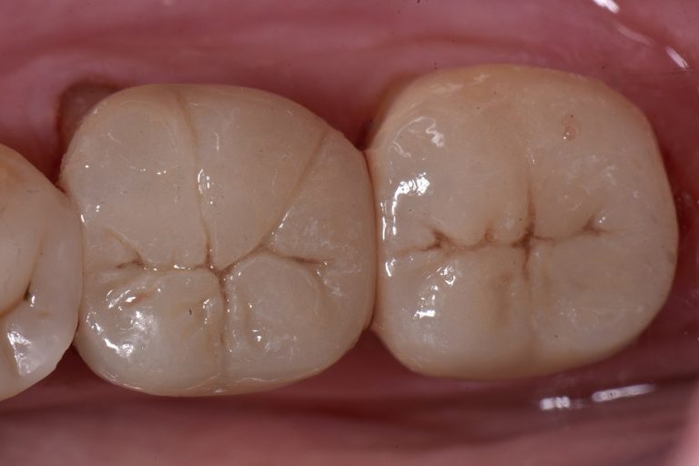 Replacing Large Amalgam Fillings Bonded Porcelain Crowns Cosmetic