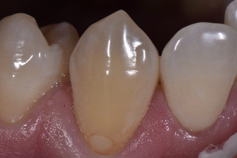 Revitalizing Old Fillings Cosmetic Dentist Auckland