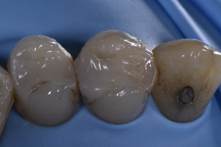 Cosmetic Restorations Cosmetic Dentist Auckland