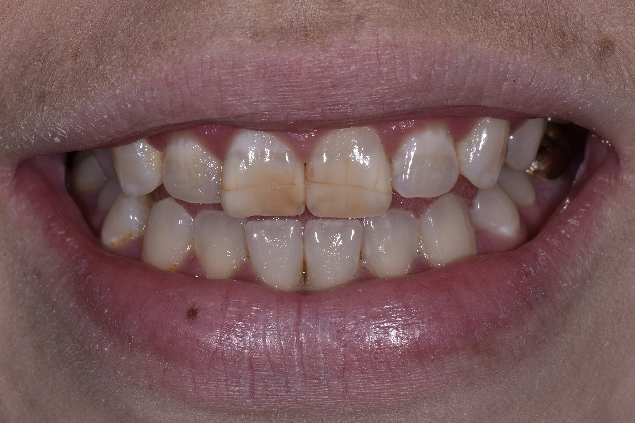 Rejuvenation of Dark, Cracked Teeth with Composite Veneers