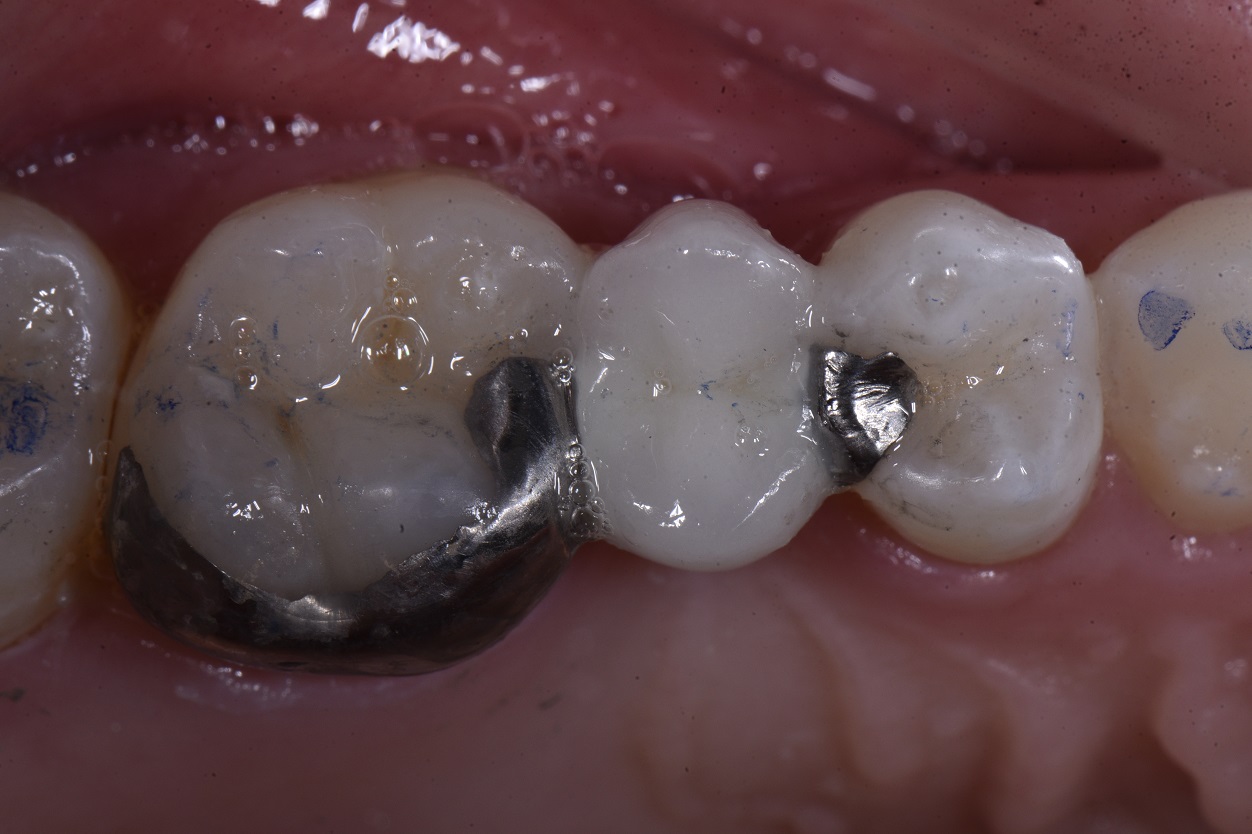 NonInvasive Dentistry Minimally Invasive Cosmetic Dentist Auckland