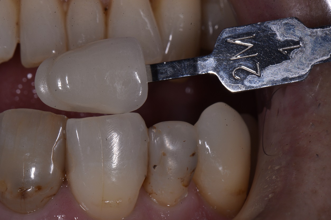 Peg Lateral Incisor Porcelain Crowns Cosmetic Dentist Auckland