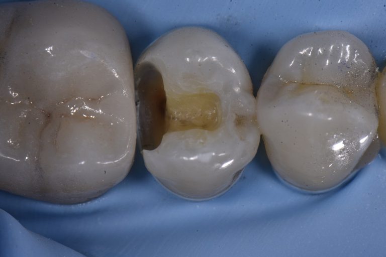 Safe Removal of Amalgam Fillings Restorative Dentist Auckland