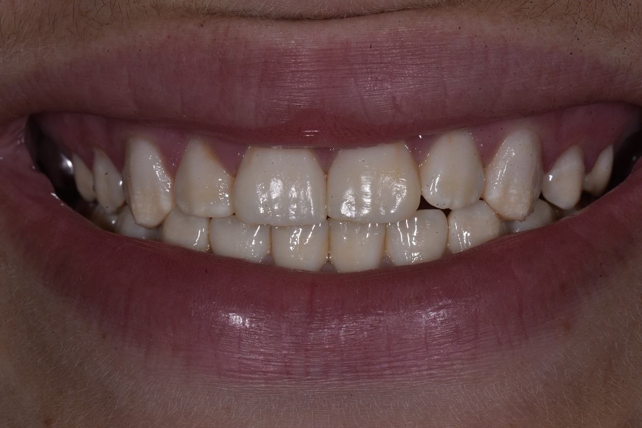 Tooth Whitening Dental Whitening Vital Custom Nightguard Bleaching