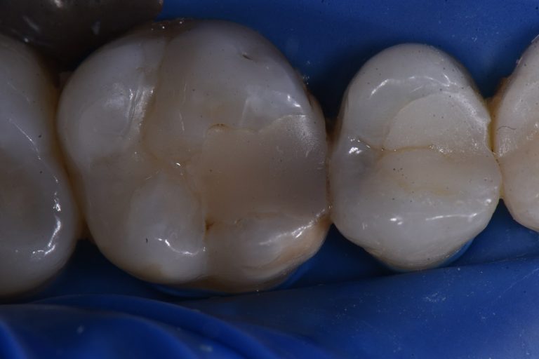 Posterior Composite Restorations Fillings Restorative Dentistry Auckland