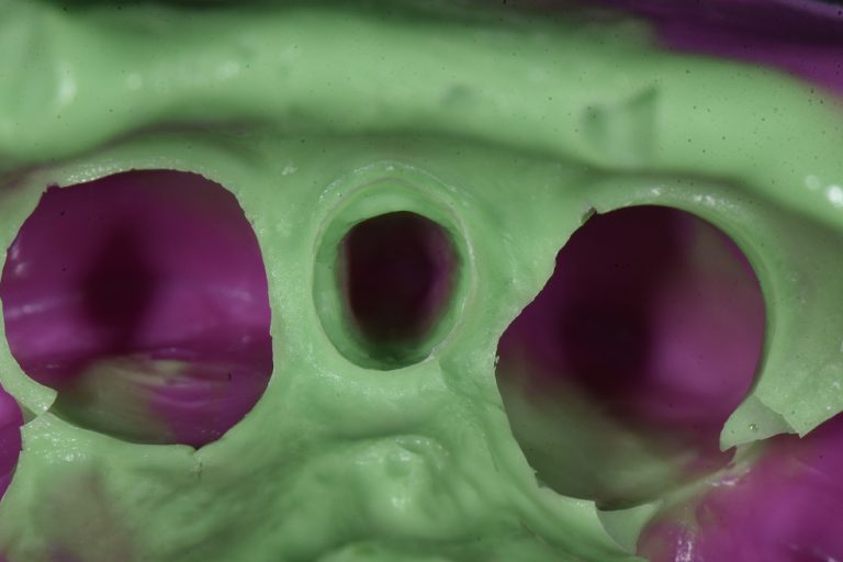 Dental Crowns Impression Precision Restorative Dentistry Auckland