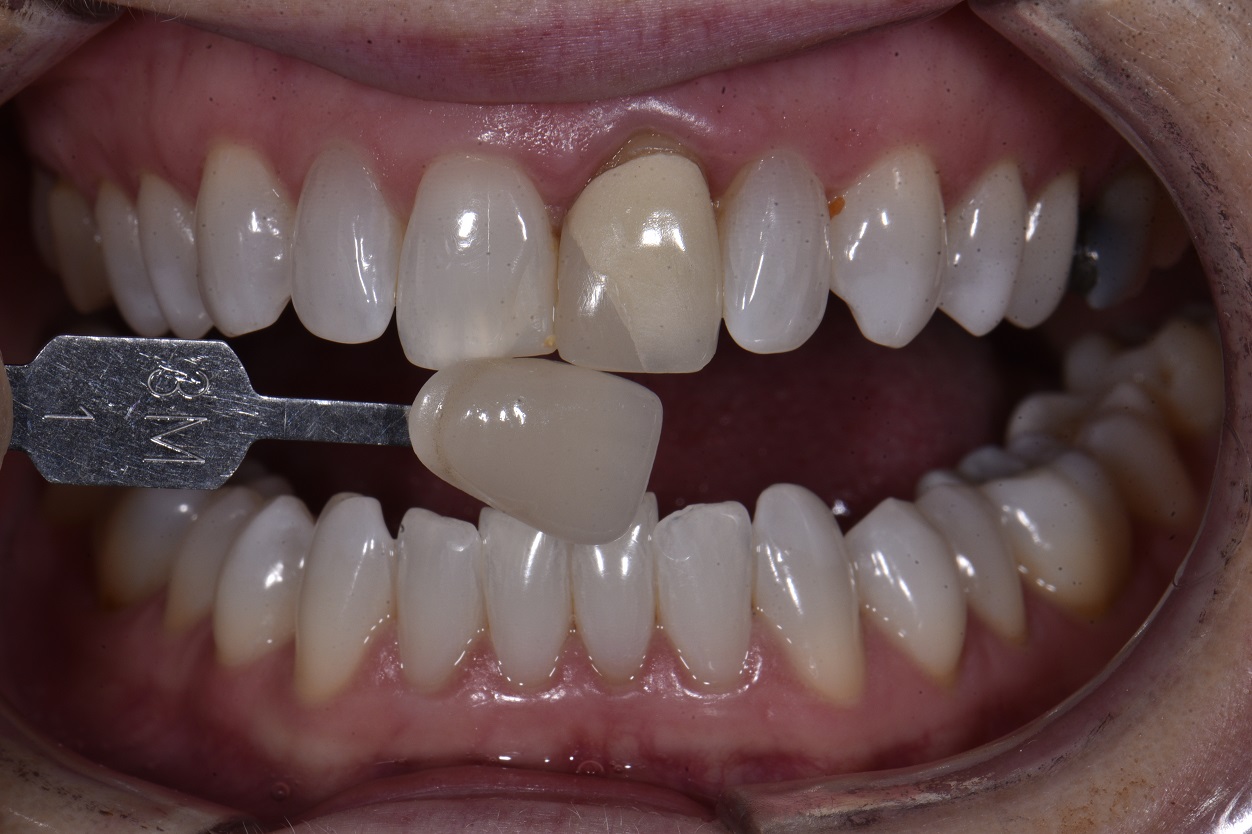 Porcelain Veneers & Crowns Complex Anterior Bonded Dentistry