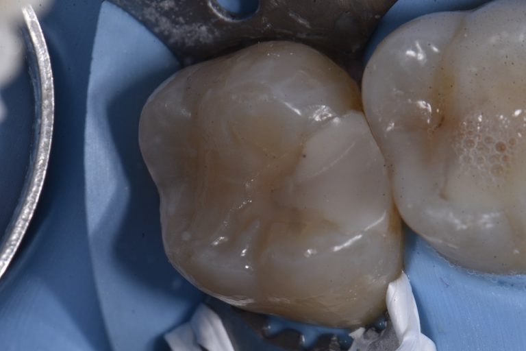 Temporary Filling Replacement White Fillings Auckland