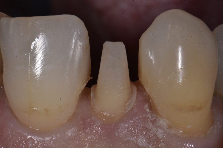 Peg Lateral Incisor Porcelain Crowns Cosmetic Dentist Auckland