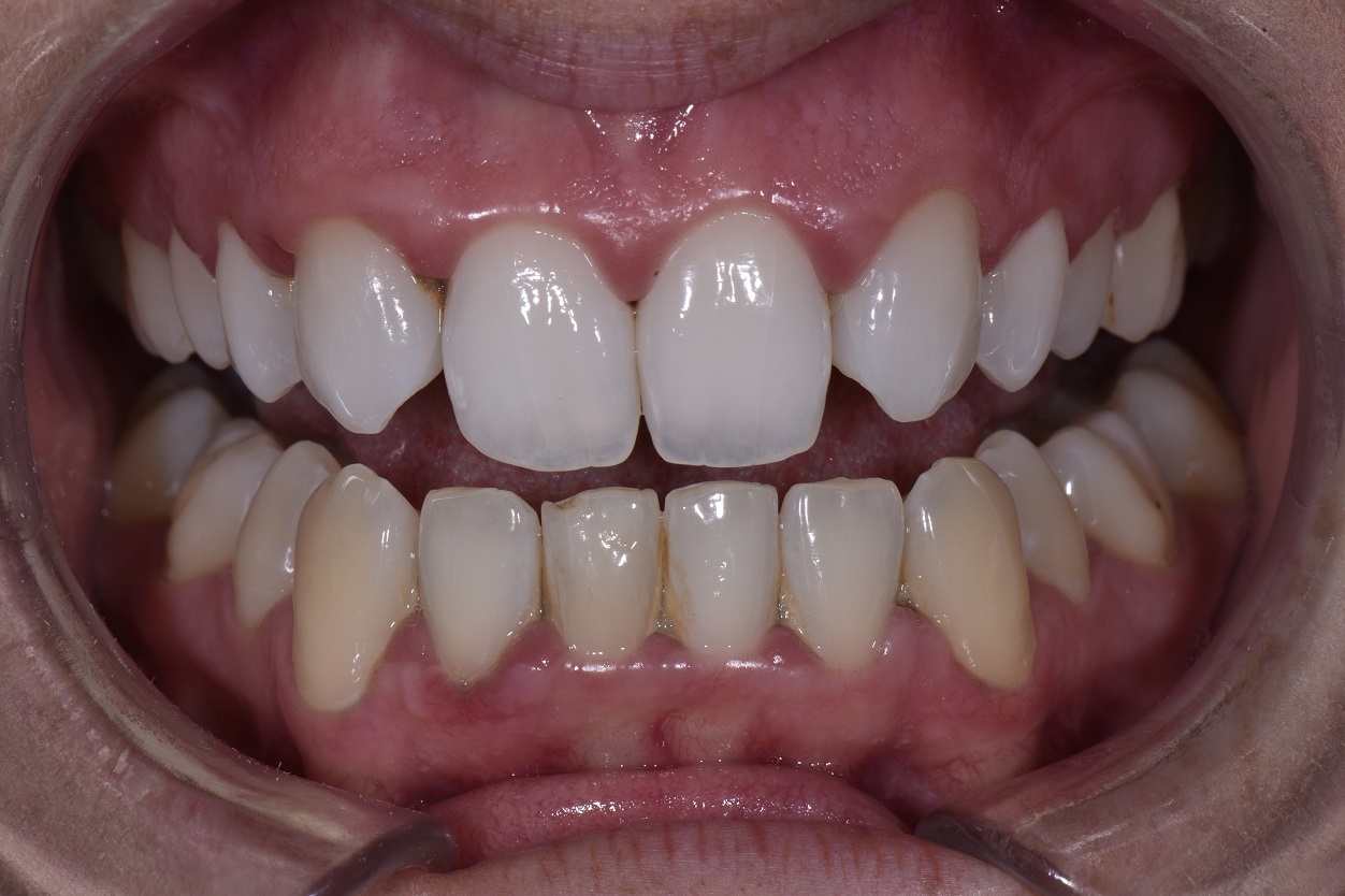 Correction of Missing Lateral Incisors Using Digital Smile Design