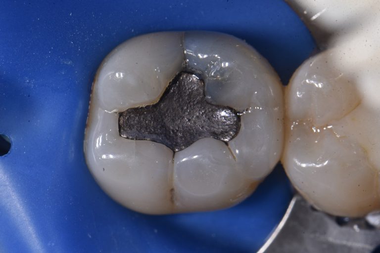 Amalgams and Cracked Teeth Restorative Dentistry Auckland