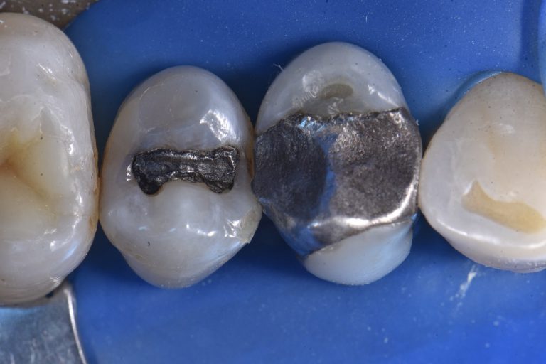 Mercury Removal White Fillings Dentist Auckland