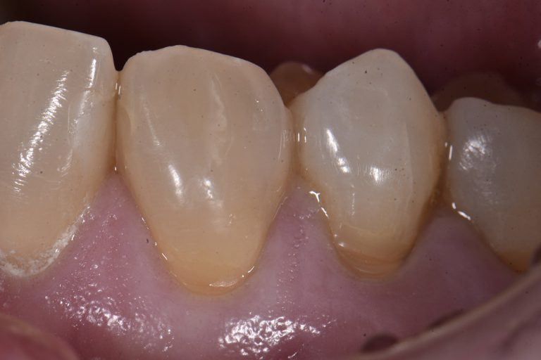 Composite Restorations Tooth Wear Abrasion