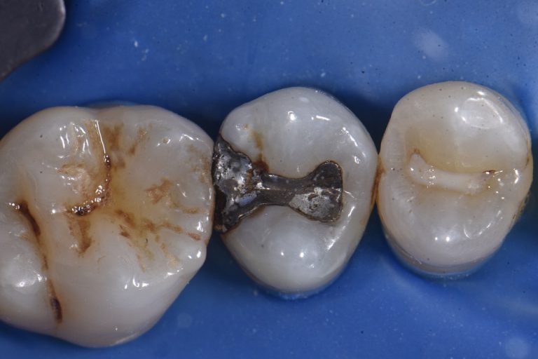 Amalgam Replacement with Composite Resin