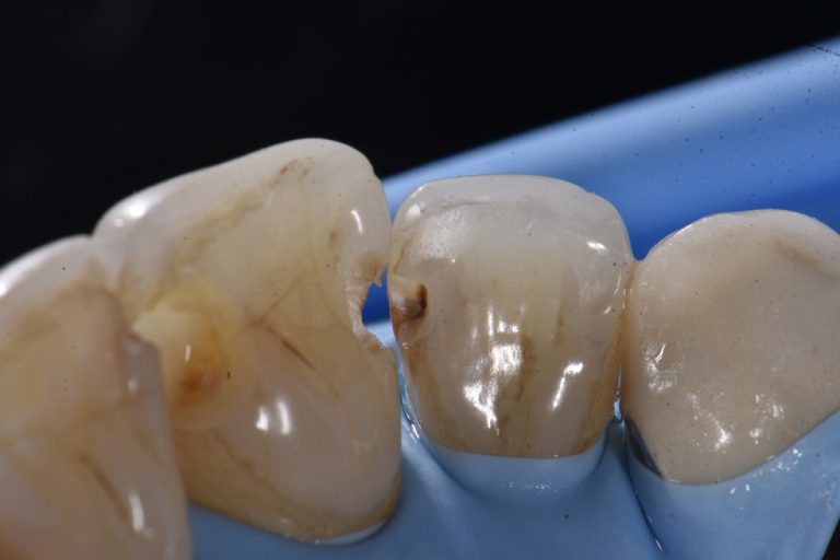 Class III caries Restorative Dentistry Auckland
