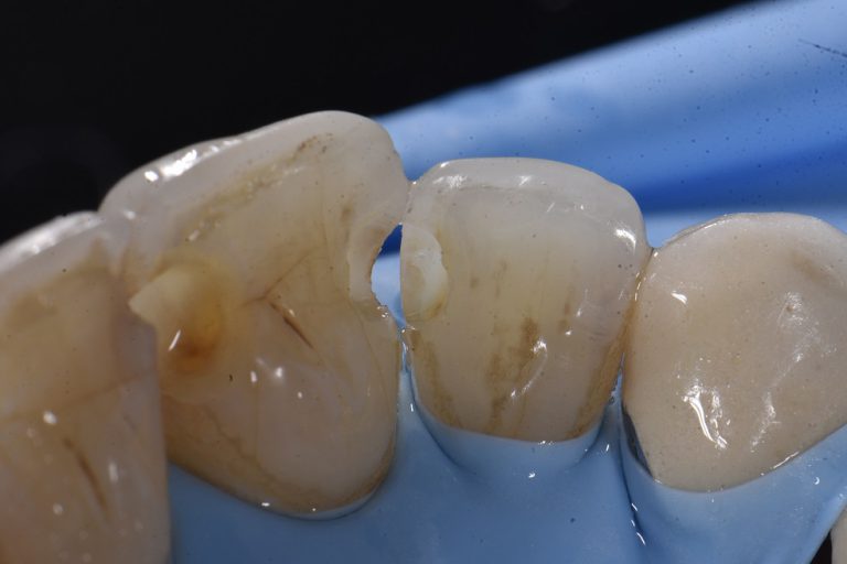 Class III caries Restorative Dentistry Auckland