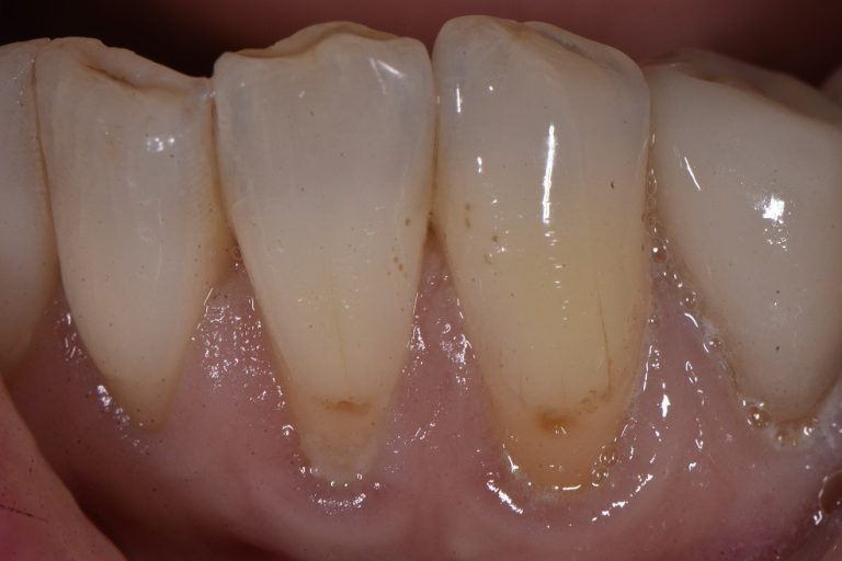 Cavities At The Necks Of Teeth Cervical Caries And Abrasion Lesions