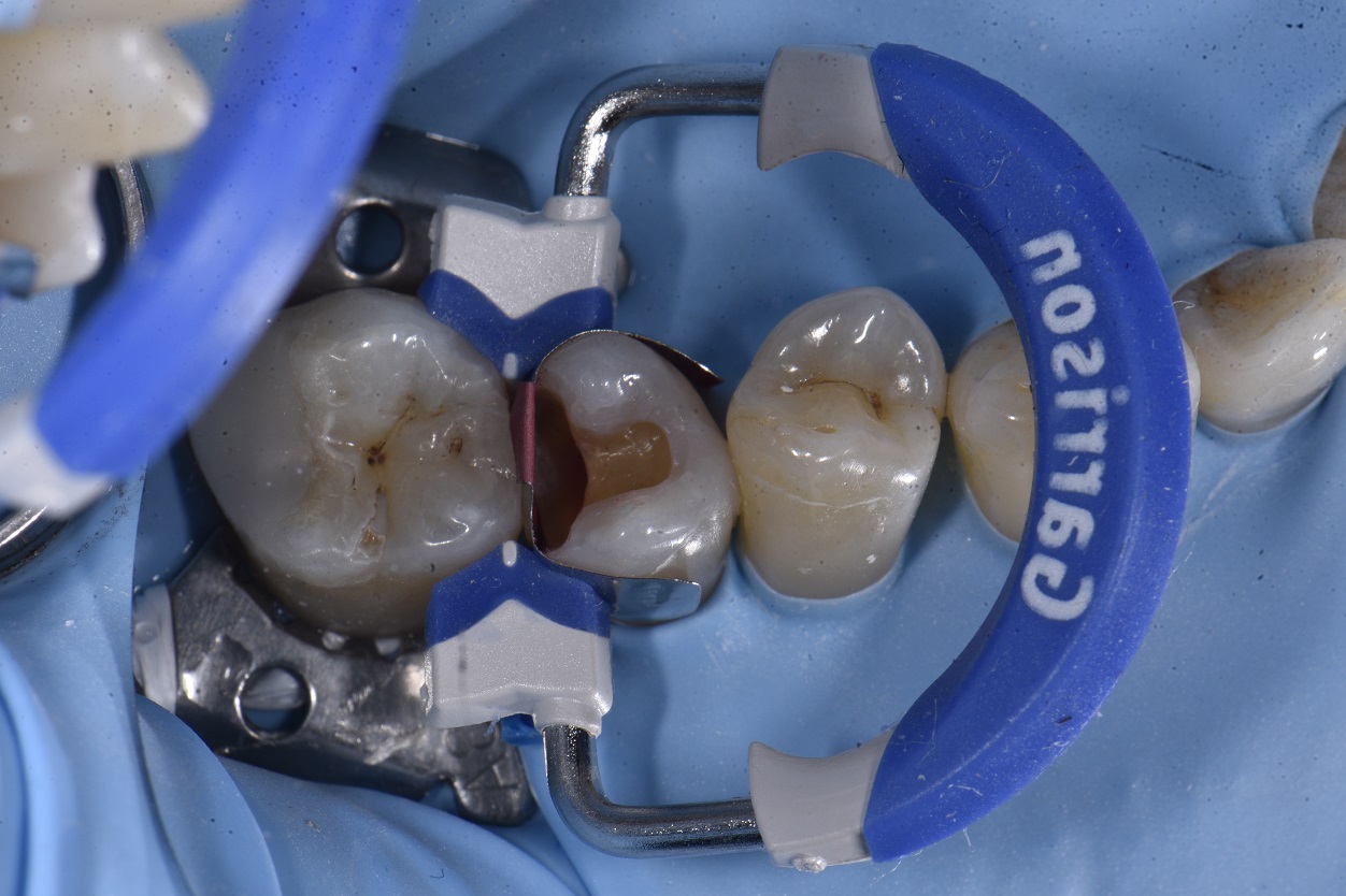 Amalgam Mercury Filling Removal White Fillings Auckland