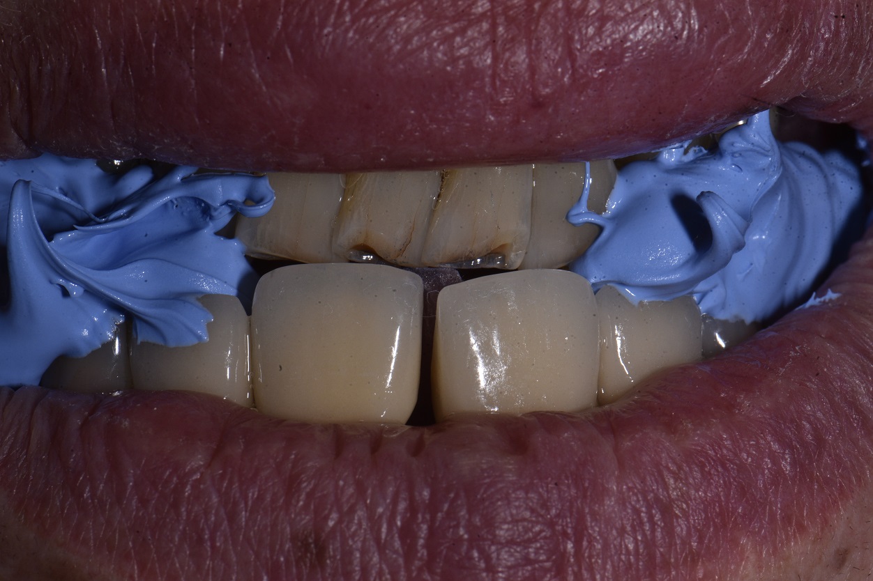 Kois Deprogrammer and OVD setup for dental rehabilitation